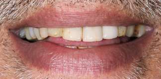 Smile Designing Using Porcelain Veneers By Dr. Aastha Chandra At Opal Dental Care Studio, Mumbai, India.