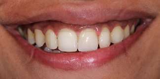 Full Mouth Rehabilitation Using Zirconia Crowns And Implants By Dr. Aastha Chandra At Opal Dental Care Studio, Mumbai, India