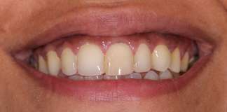 Full Mouth Rehabilitation Using Zirconia Crowns And Implants By Dr. Aastha Chandra At Opal Dental Care Studio, Mumbai, India