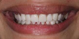 Smile Designing Using Porcelain Veneers By Dr. Aastha Chandra At Opal Dental Care Studio, Mumbai, India.
