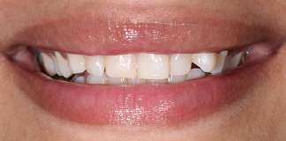 Smile Designing Using Porcelain Veneers By Dr. Aastha Chandra At Opal Dental Care Studio, Mumbai, India.