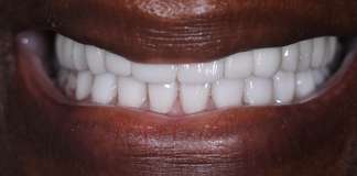 Full Mouth Rehabilitation Using Zirconia Crowns And Implants By Dr. Aastha Chandra At Opal Dental Care Studio, Mumbai, India