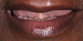 Full Mouth Rehabilitation Using Zirconia Crowns And Implants By Dr. Aastha Chandra At Opal Dental Care Studio, Mumbai, India