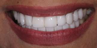 Smile Designing Using Porcelain Veneers By Dr. Aastha Chandra At Opal Dental Care Studio, Mumbai, India.