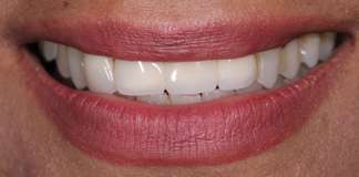 Smile Designing Using Porcelain Veneers By Dr. Aastha Chandra At Opal Dental Care Studio, Mumbai, India.