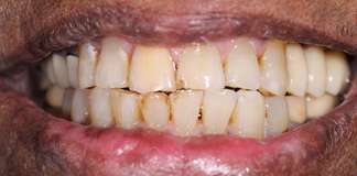 Full Mouth Rehabilitation Using Zirconia Crowns And Implants By Dr. Aastha Chandra At Opal Dental Care Studio, Mumbai, India