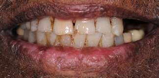 Full Mouth Rehabilitation Using Zirconia Crowns And Implants By Dr. Aastha Chandra At Opal Dental Care Studio, Mumbai, India