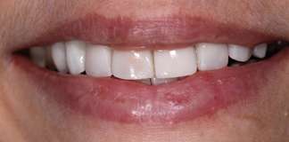 Smile Designing Using Porcelain Veneers By Dr. Aastha Chandra At Opal Dental Care Studio, Mumbai, India.