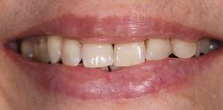 Smile Designing Using Porcelain Veneers By Dr. Aastha Chandra At Opal Dental Care Studio, Mumbai, India.