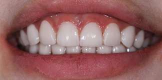 Full Mouth Rehabilitation Using Zirconia Crowns And Implants By Dr. Aastha Chandra At Opal Dental Care Studio, Mumbai, India