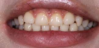 Full Mouth Rehabilitation Using Zirconia Crowns And Implants By Dr. Aastha Chandra At Opal Dental Care Studio, Mumbai, India