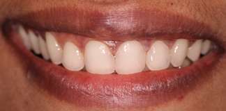 Full Mouth Rehabilitation Using Zirconia Crowns And Implants By Dr. Aastha Chandra At Opal Dental Care Studio, Mumbai, India
