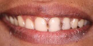 Full Mouth Rehabilitation Using Zirconia Crowns And Implants By Dr. Aastha Chandra At Opal Dental Care Studio, Mumbai, India