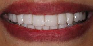 Full Mouth Rehabilitation Using Zirconia Crowns And Implants By Dr. Aastha Chandra At Opal Dental Care Studio, Mumbai, India