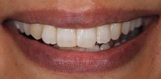 Full Mouth Rehabilitation Using Zirconia Crowns And Implants By Dr. Aastha Chandra At Opal Dental Care Studio, Mumbai, India