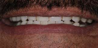 Full Mouth Rehabilitation Using Zirconia Crowns And Implants By Dr. Aastha Chandra At Opal Dental Care Studio, Mumbai, India