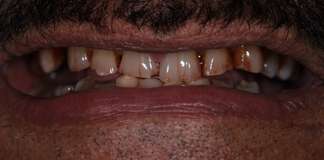 Full Mouth Rehabilitation Using Zirconia Crowns And Implants By Dr. Aastha Chandra At Opal Dental Care Studio, Mumbai, India