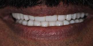 Full Mouth Rehabilitation Using Zirconia Crowns And Implants By Dr. Aastha Chandra At Opal Dental Care Studio, Mumbai, India
