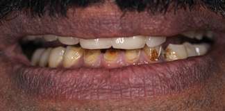 Full Mouth Rehabilitation Using Zirconia Crowns And Implants By Dr. Aastha Chandra At Opal Dental Care Studio, Mumbai, India